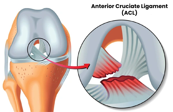 Anterior Cruciate Ligament (acl) Reconstruction