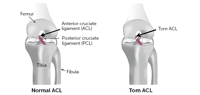 Anterior cruciate ligament ACL