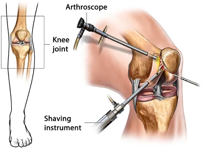 Conditions Can Be Treated with Knee Arthroscopy