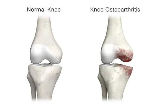 post-traumatic arthritis