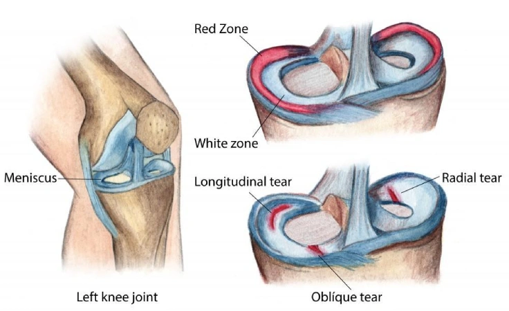 meniscus repair