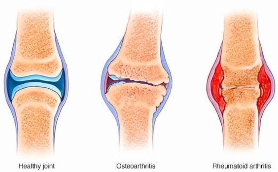 Rheumatoid Arthritis