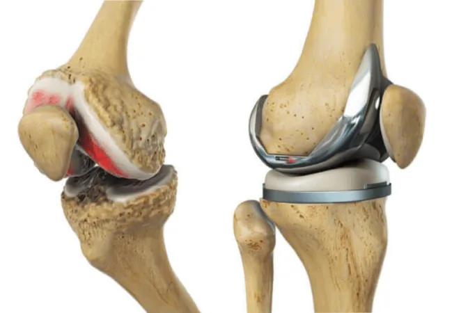 Total Knee Replacement B_L