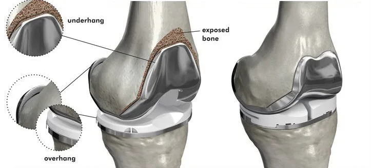 condition of Bilateral Knee Replacement