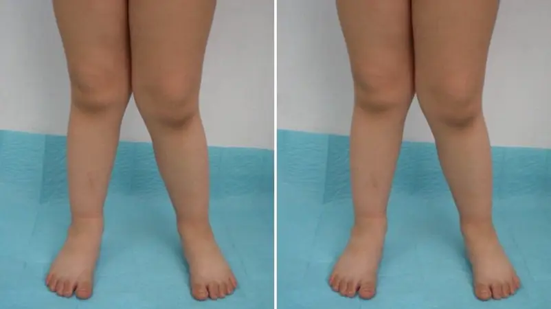 deformed knees results