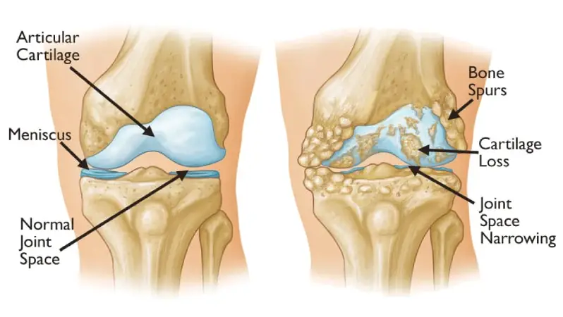 post-traumatic arthritis