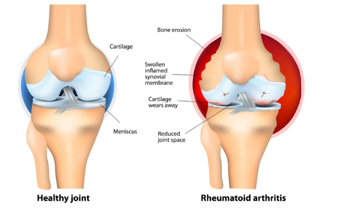 rheumatoid arthritis knee