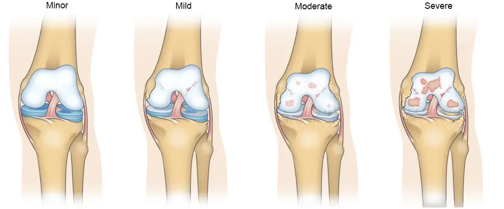 Stages of Knee osteoarthritis