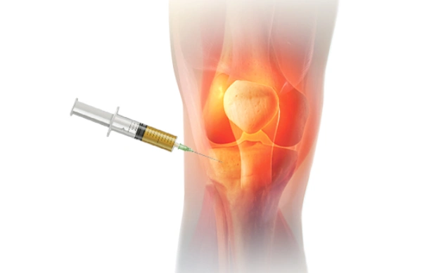 Anterior Cruciate Ligament (acl) Reconstruction