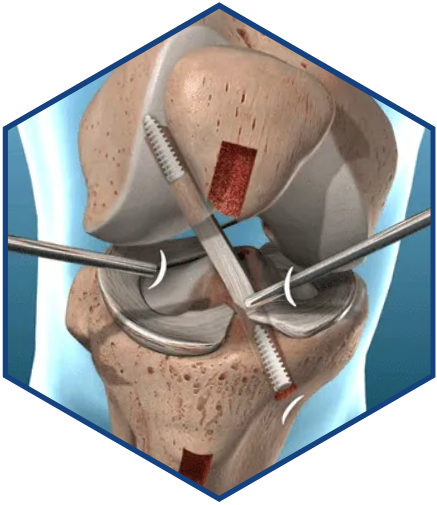 meniscus repair