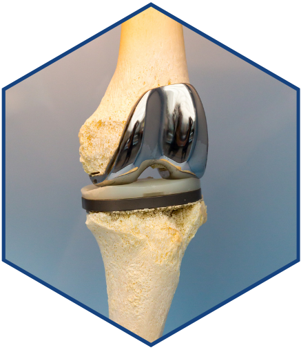 Knee Replacement