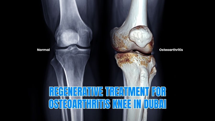 Regenerative Treatment for Osteoarthritis Knee in Dubai